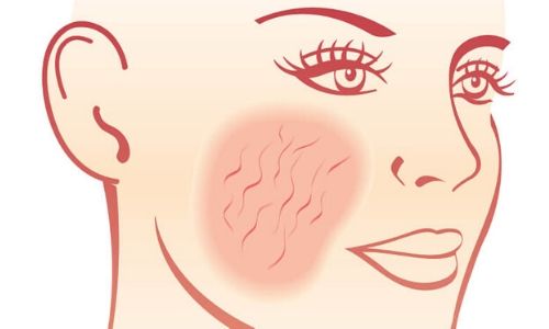 What causes Rosacea